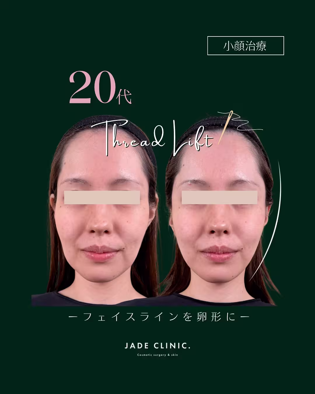 20s-thread-lift-hyaluronic-acid-1