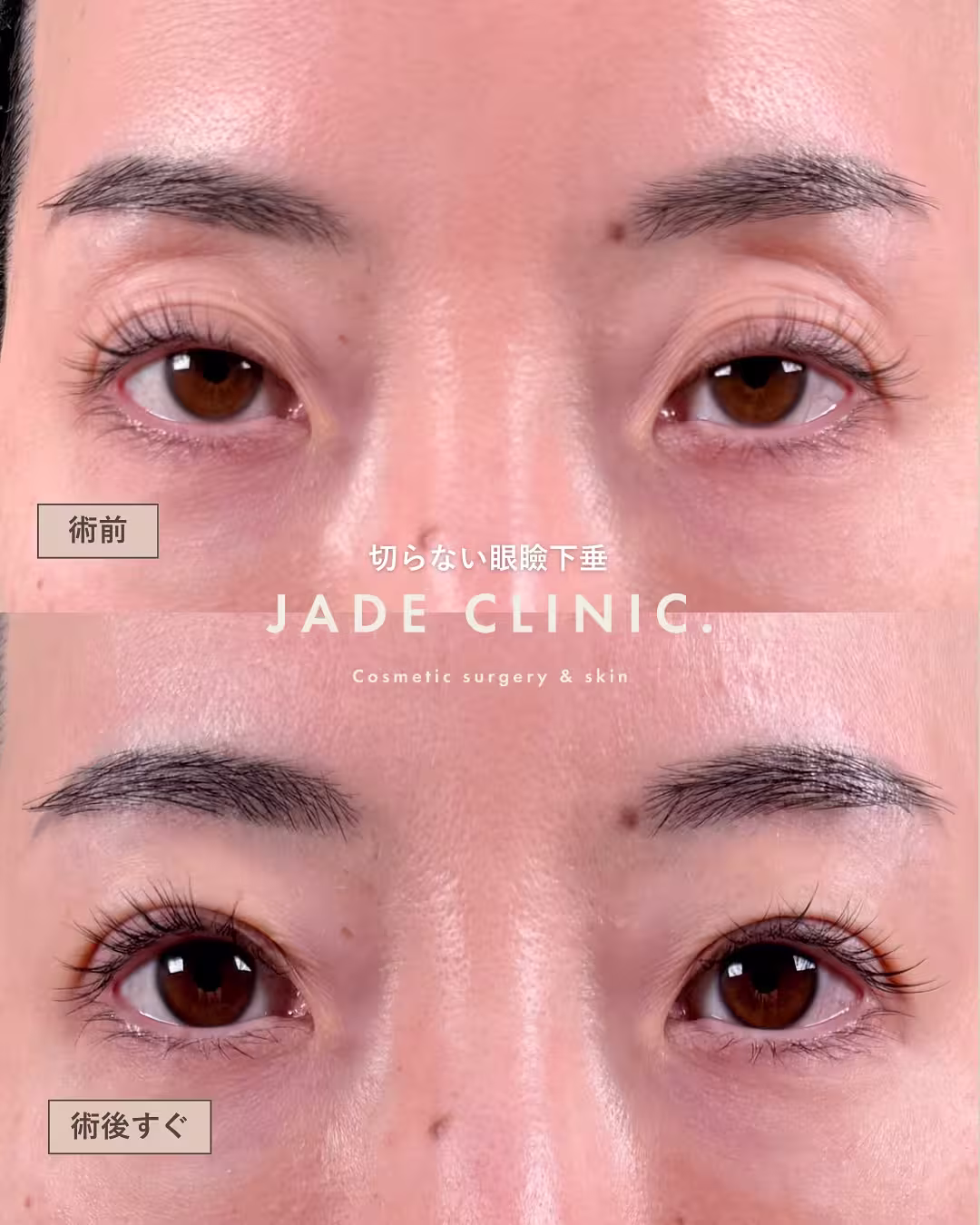 40s-non-surgical-ptosis-adhesion-1