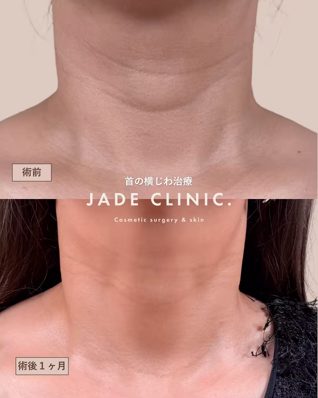 neck-wrinkle-treatment-1month-hyaluronic-acid-1