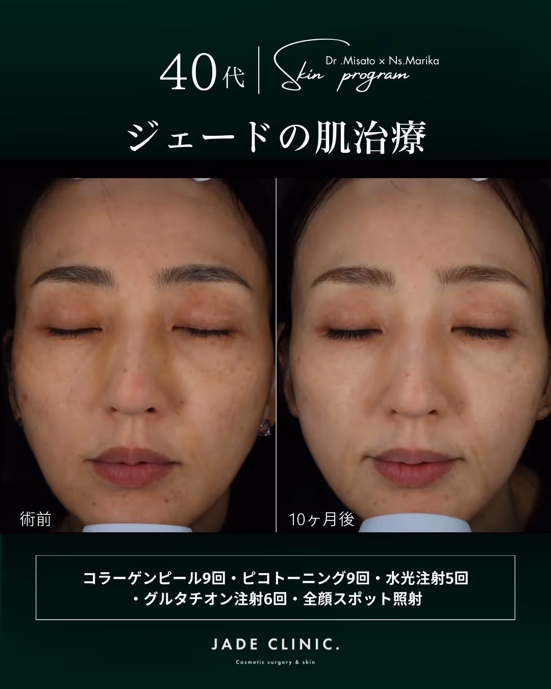 エステから美容医療へ｜シミ治療症例タイトル｜JADE CLINIC.