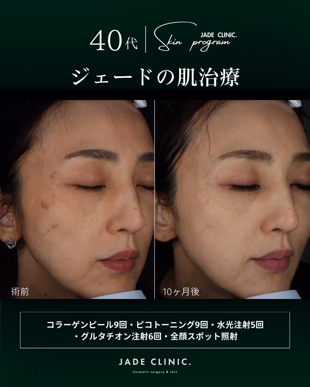 エステ施術後の赤み・色素沈着残存｜治療前のVISIA画像