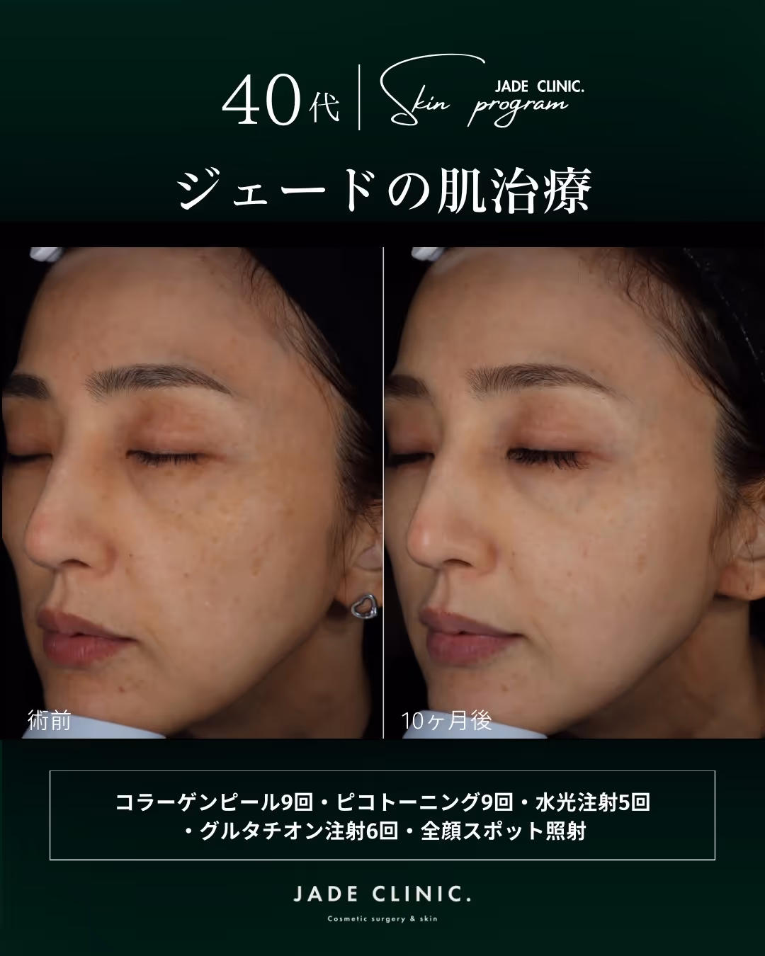 肌の土台を整える治療｜水光注射＋ピンクグロウ＋点滴の組み合わせ