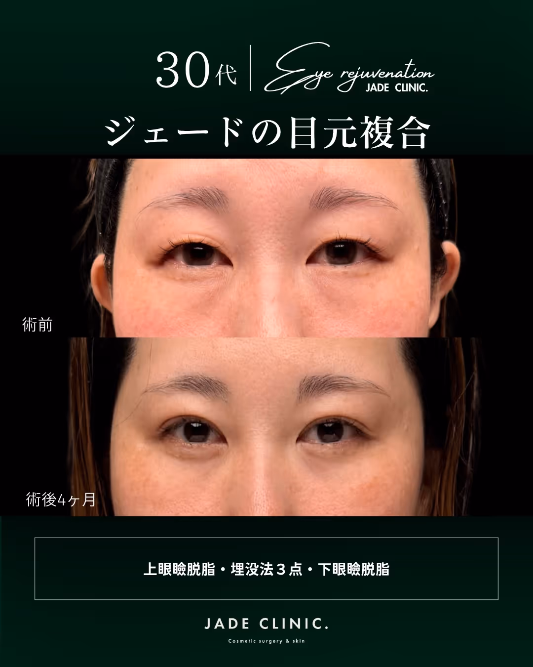 腫れぼったい目元の改善｜30代複合手術タイトル｜JADE CLINIC.