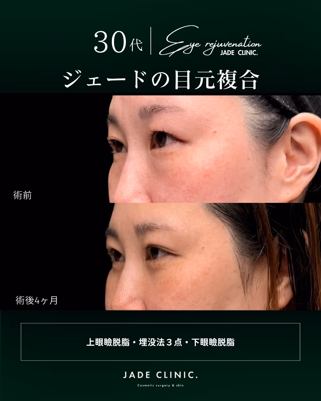 術前｜上まぶたの重たさ・下まぶたのふくらみ感
