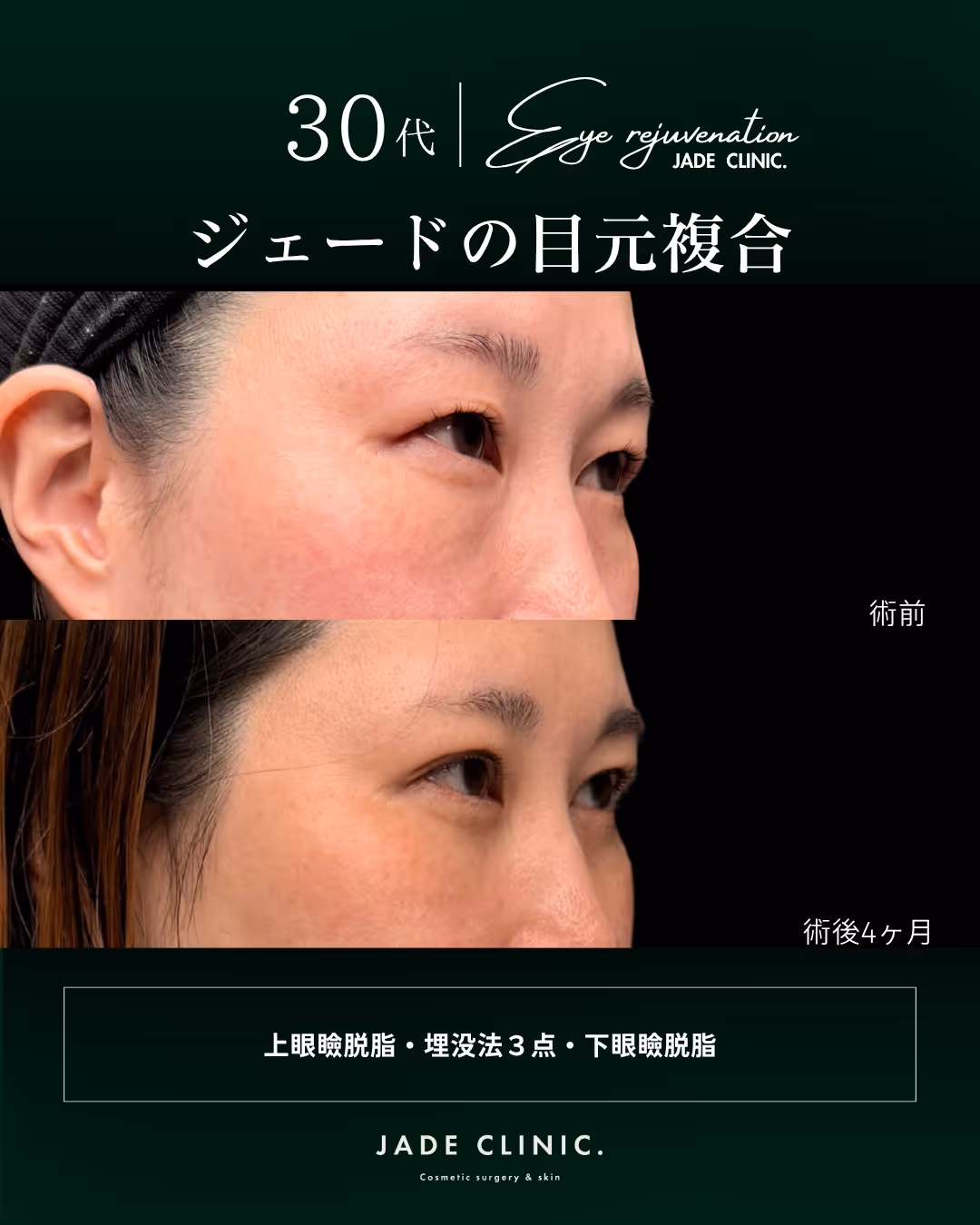 術後4ヶ月｜目の開きが軽く、黒目の見え方が変化