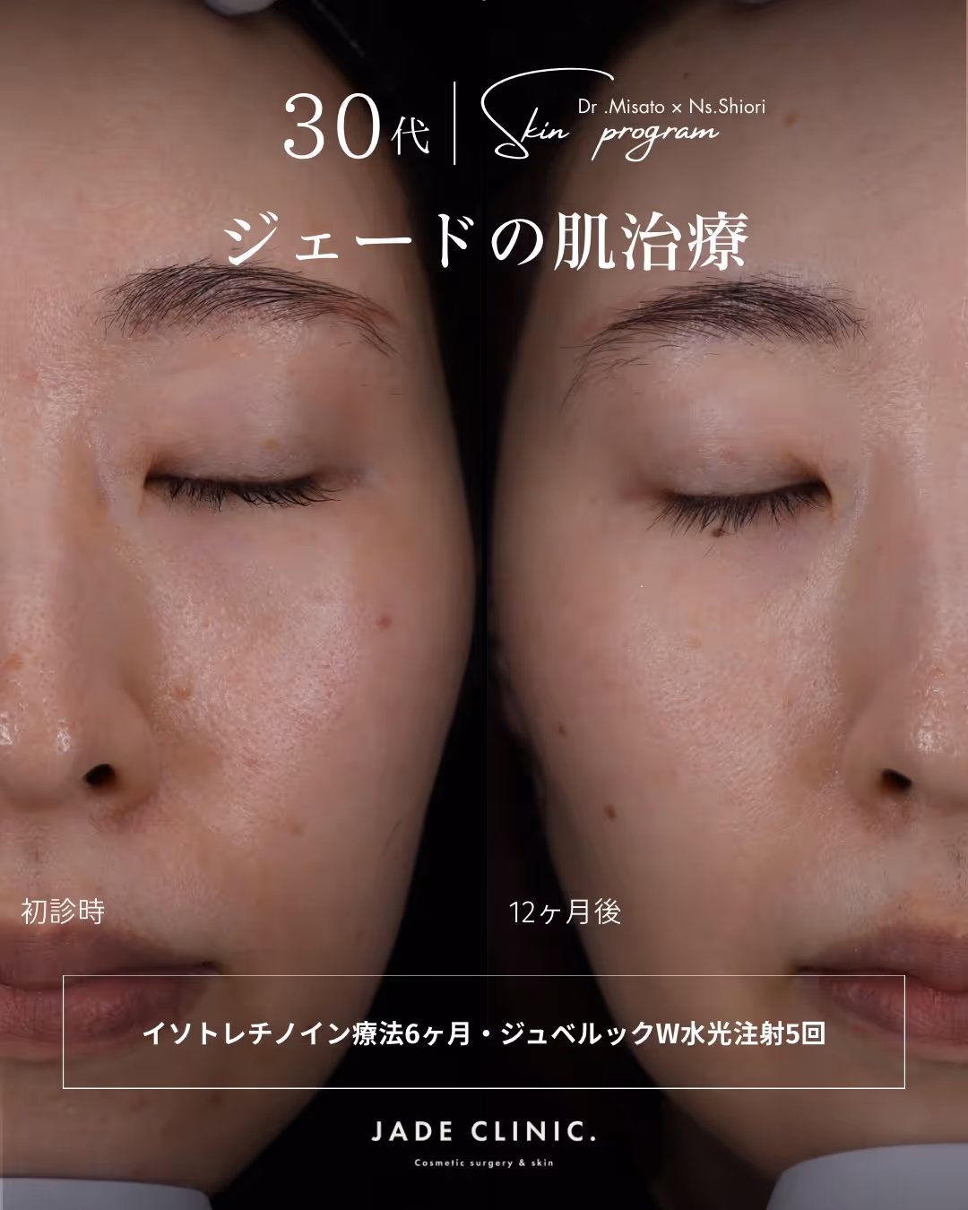 ジェードの肌治療｜30代肌質改善タイトル｜JADE CLINIC.