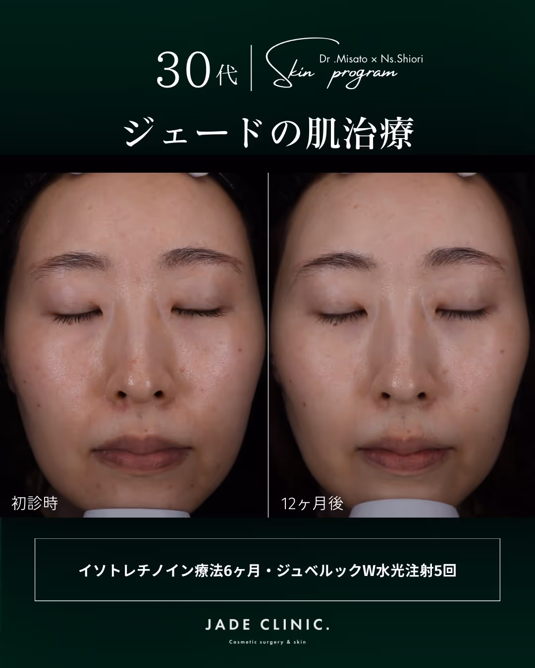 治療前｜大人ニキビ・テカリ・赤み・毛穴の開きが残る状態