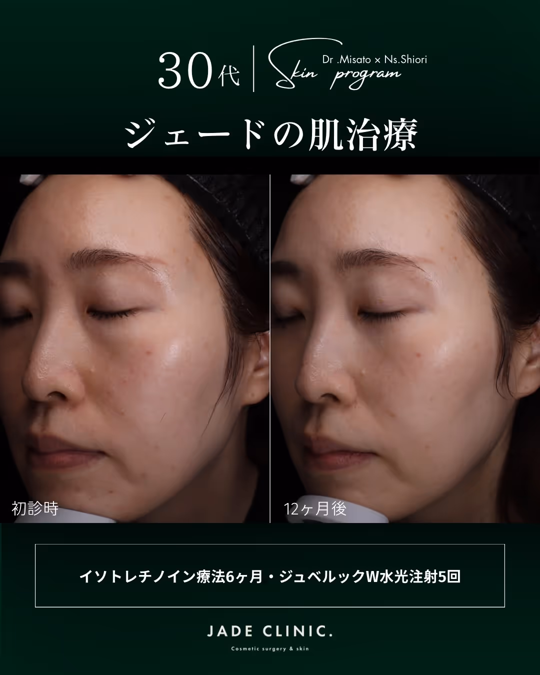 イソトレチノイン+ジュベルック水光注射の治療計画｜BELLA PRO