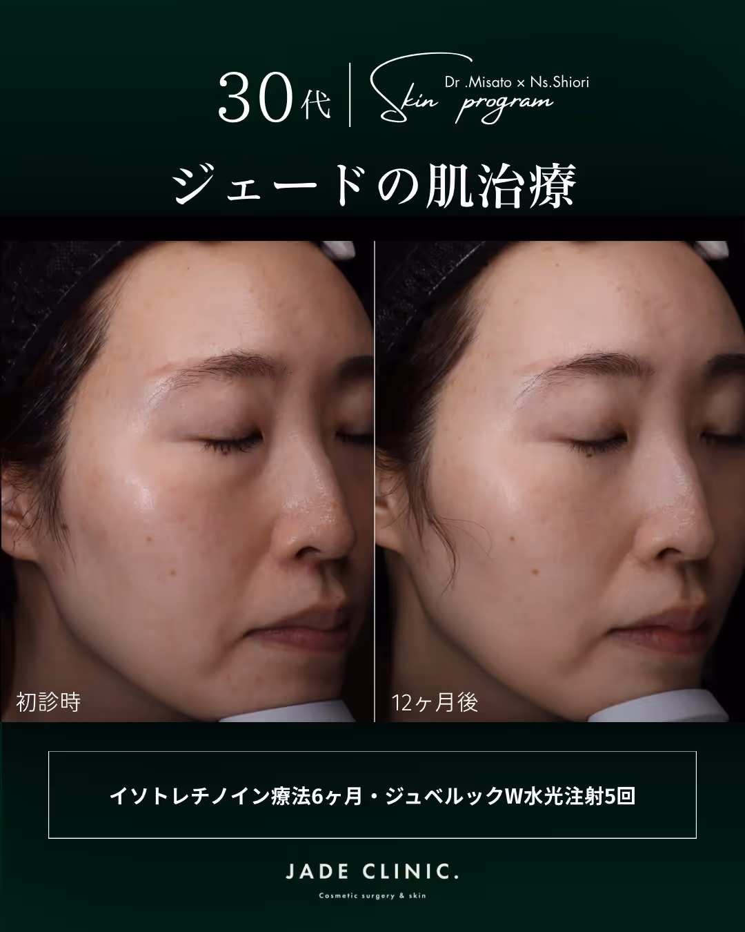 治療後｜素肌感のある白玉肌へ｜透明感・なめらかさ向上