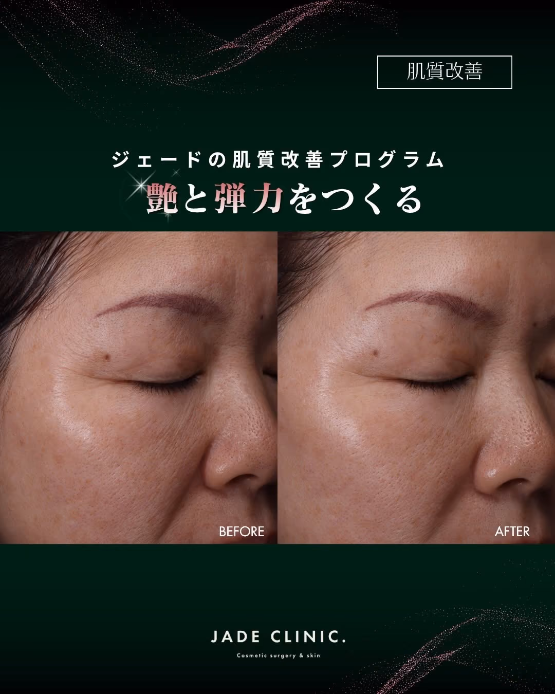 幹細胞水光注射|お肌の土台を整える症例タイトル|JADE CLINIC.