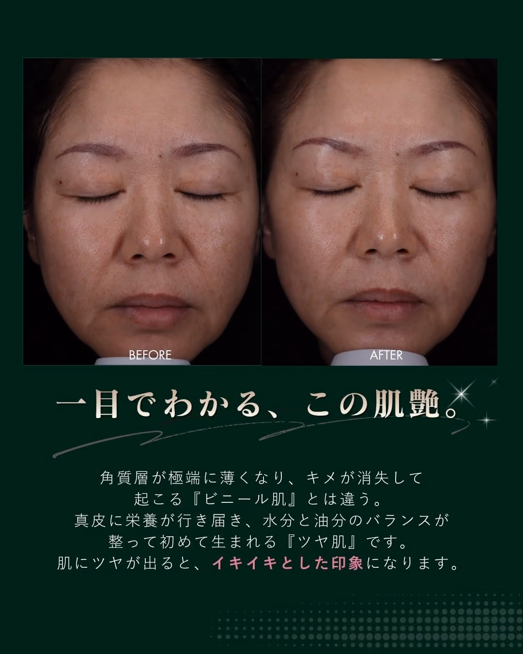 治療前|毛穴の開き・赤み・色素沈着が気になる肌