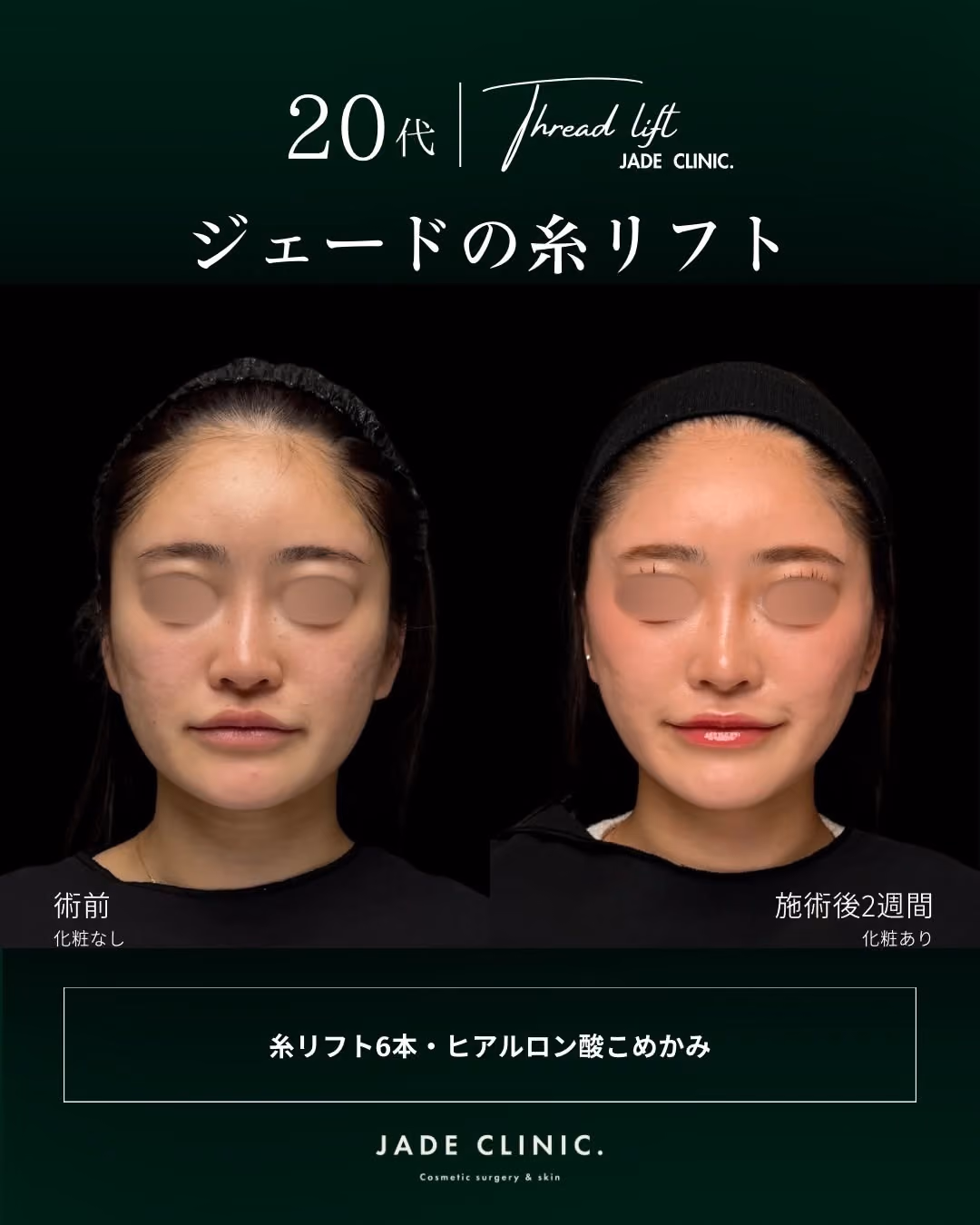 20代女性 糸リフト＋ヒアル症例タイトル｜JADE CLINIC.