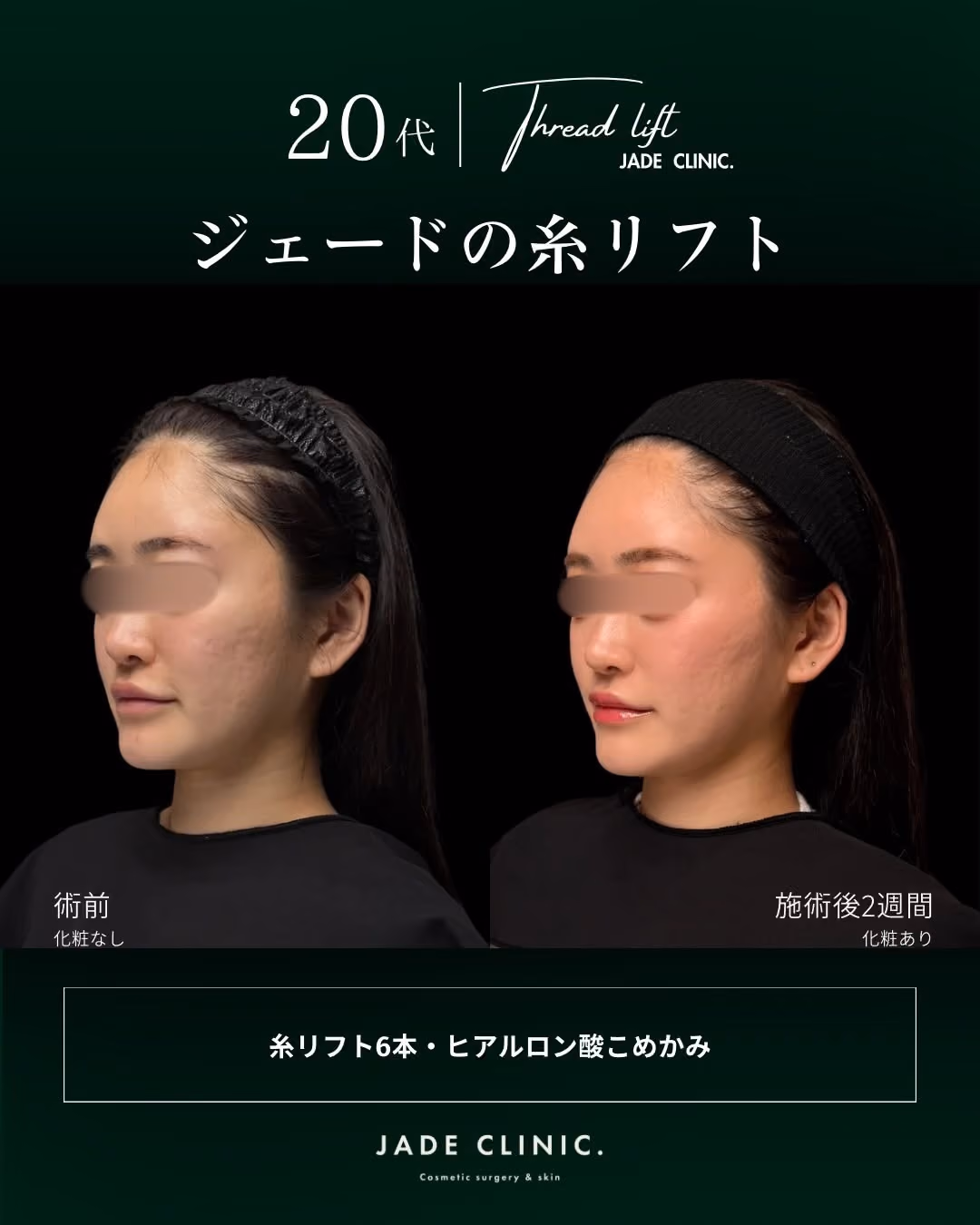 治療前｜こめかみのこけ・フェイスラインの輪郭