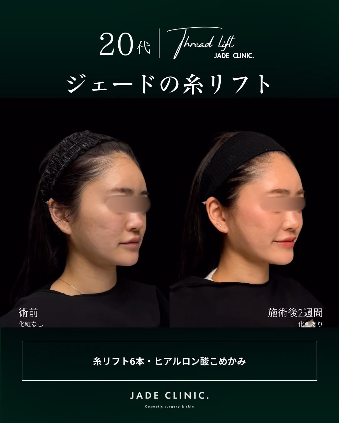 治療内容｜PCL糸リフト6本＋こめかみヒアル