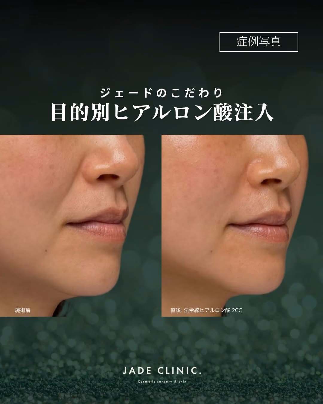 症例別ヒアルロン酸注入 No.1|JADE CLINIC.