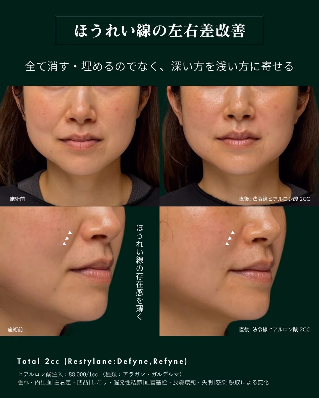 症例別ヒアルロン酸注入 No.2|JADE CLINIC.