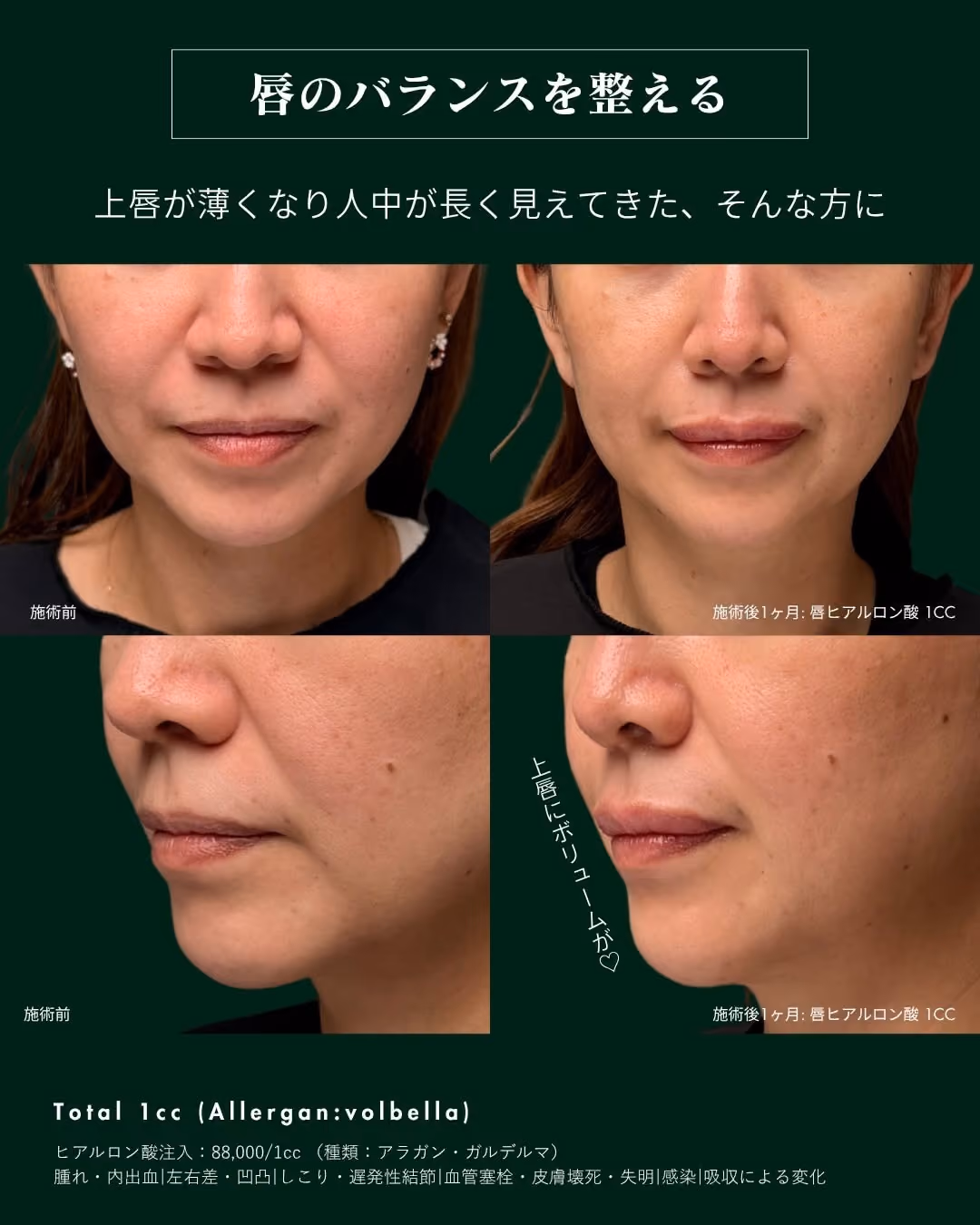 症例別ヒアルロン酸注入 No.3|JADE CLINIC.