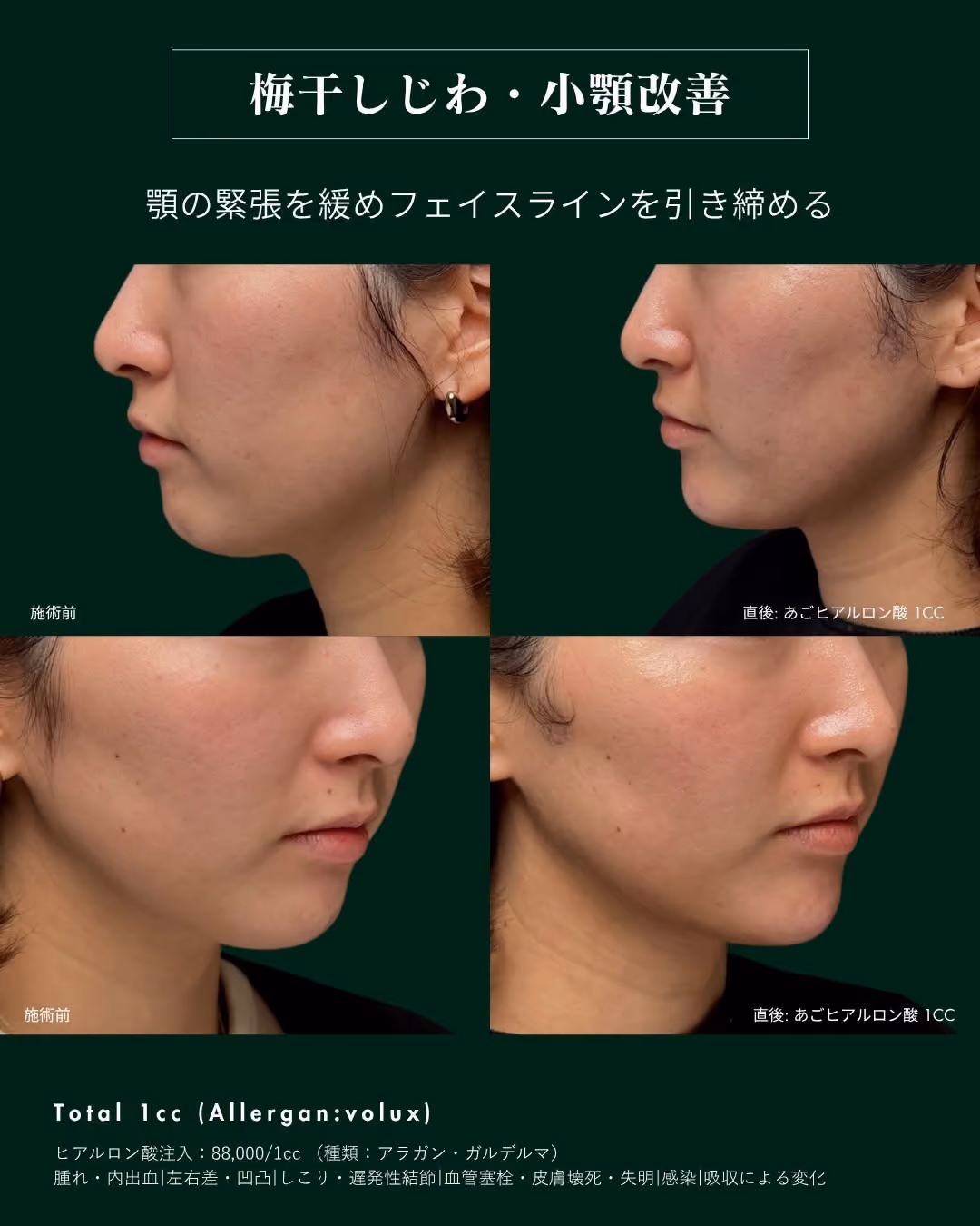 症例別ヒアルロン酸注入 No.4|JADE CLINIC.