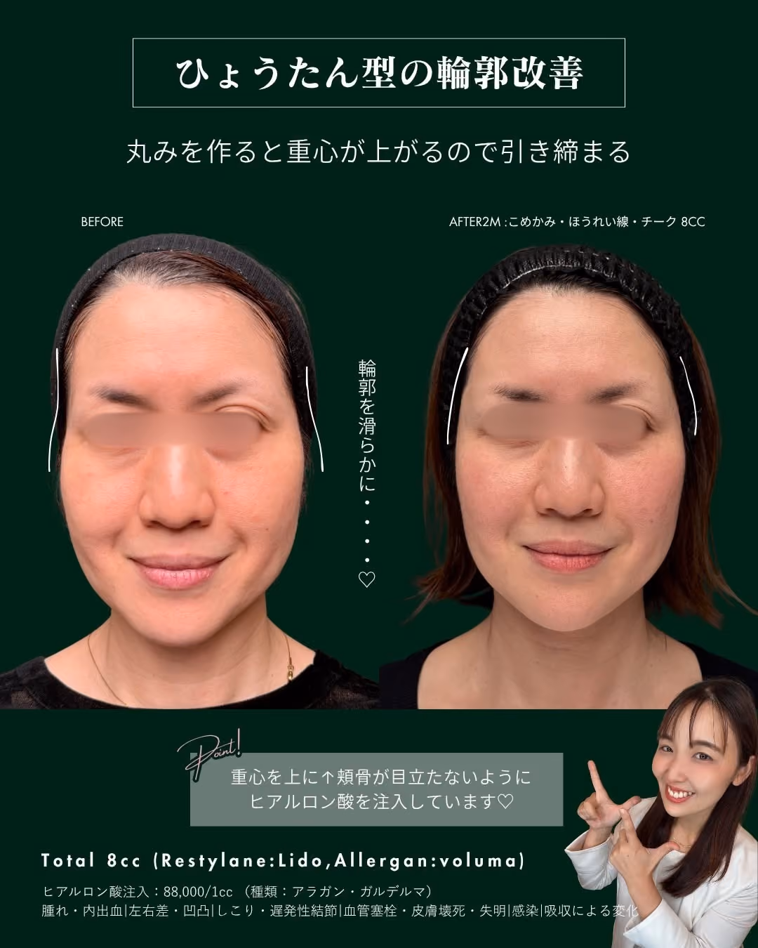 症例別ヒアルロン酸注入 No.5|JADE CLINIC.