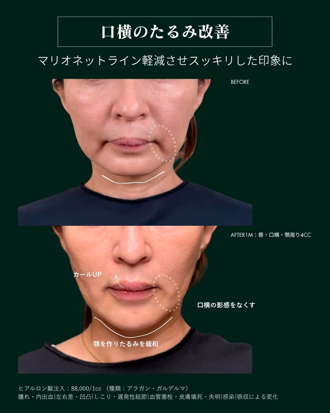 症例別ヒアルロン酸注入 No.6|JADE CLINIC.