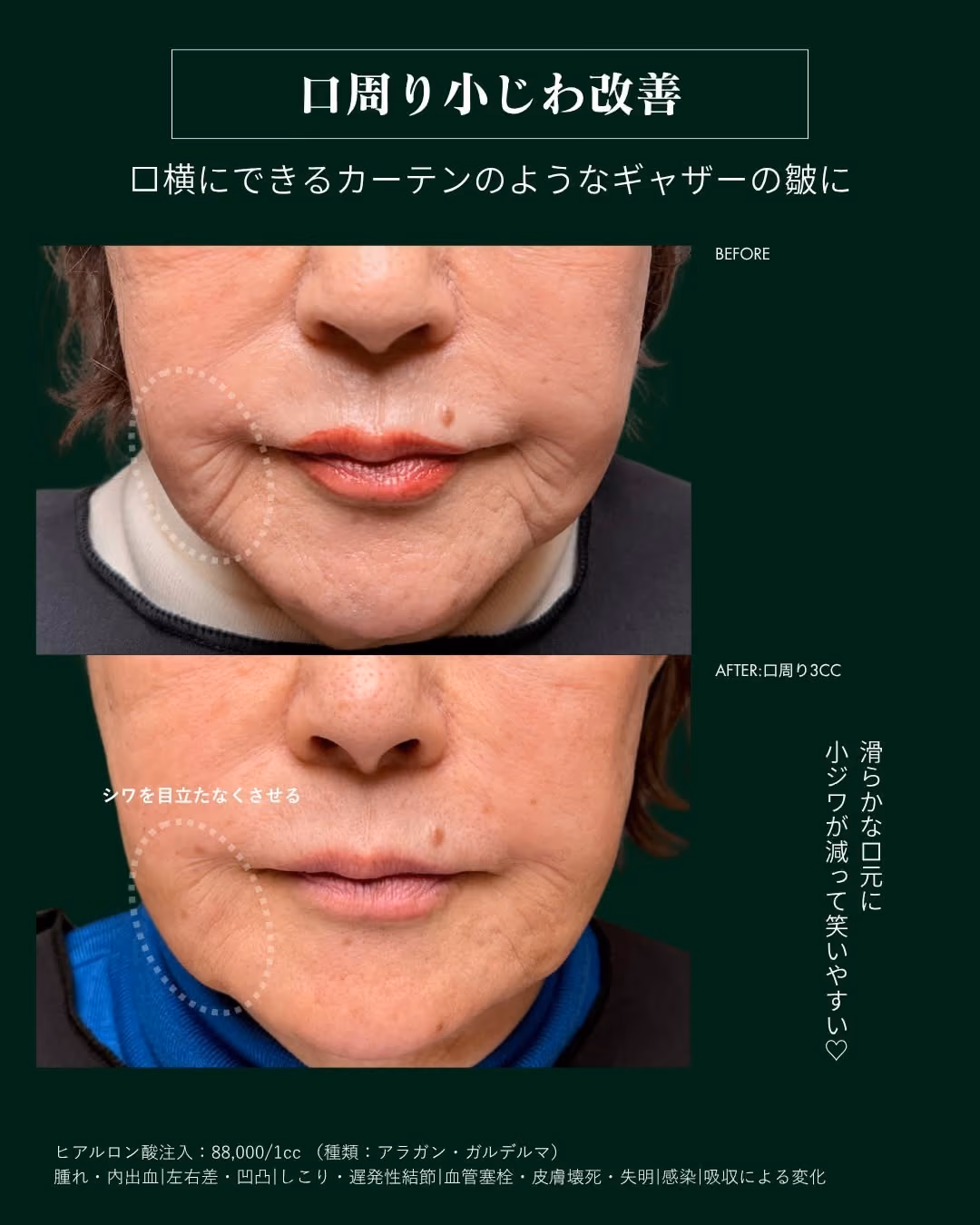 症例別ヒアルロン酸注入 No.7|JADE CLINIC.