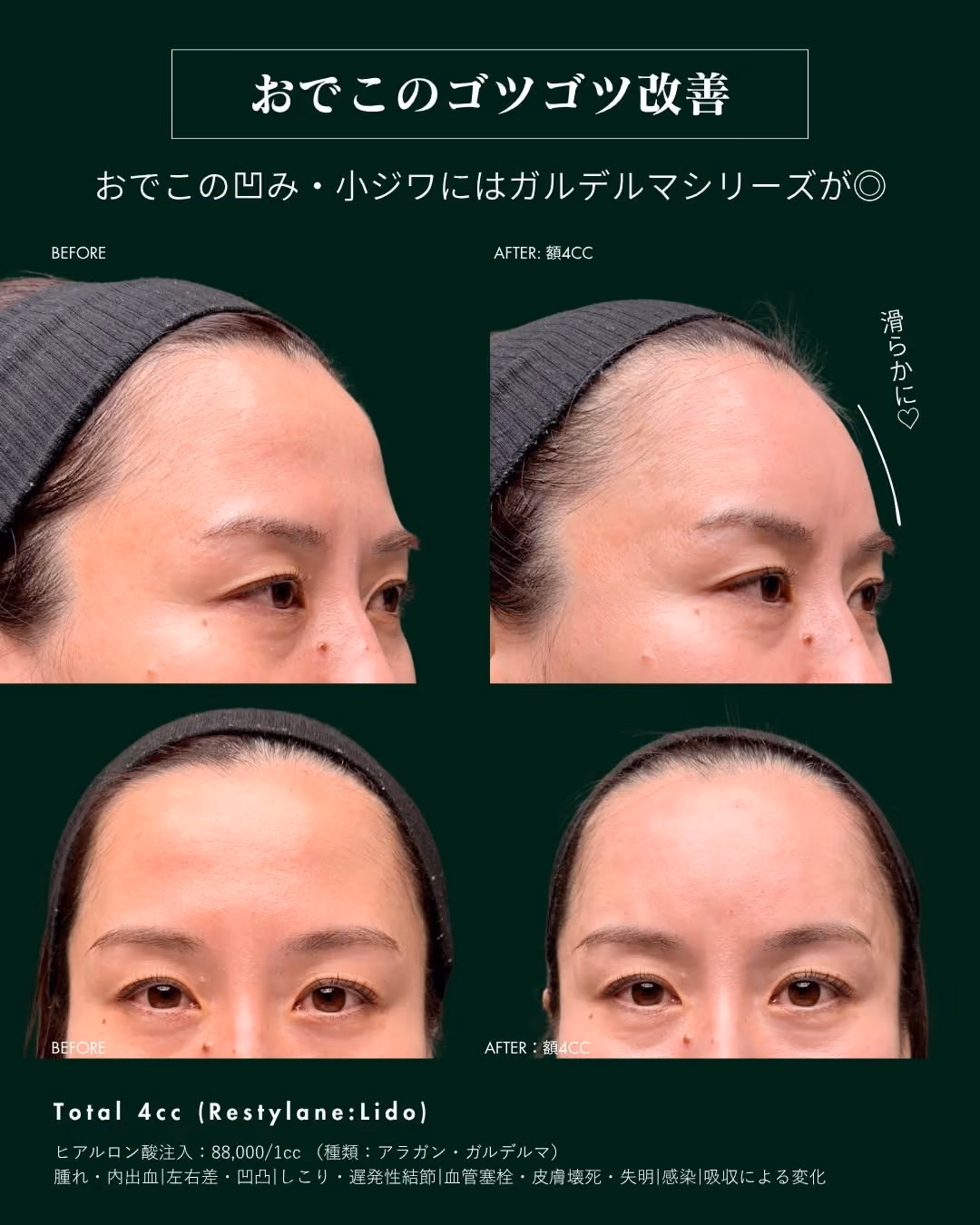 症例別ヒアルロン酸注入 No.8|JADE CLINIC.
