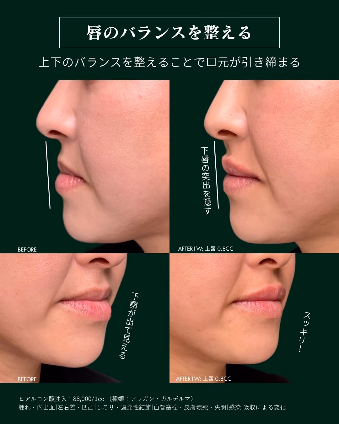 症例別ヒアルロン酸注入 No.9|JADE CLINIC.