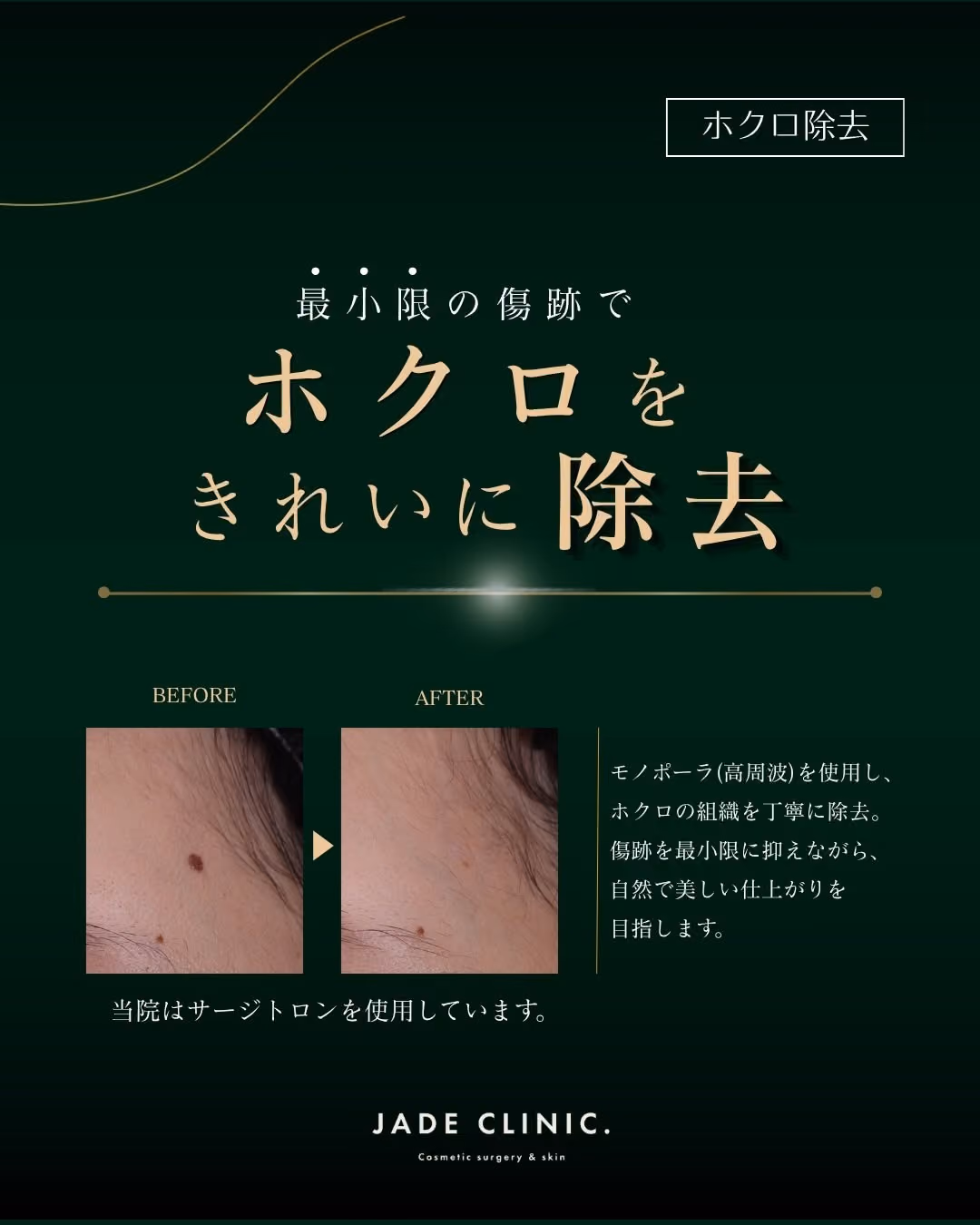 ほくろ除去|美容外科の小手術症例タイトル|JADE CLINIC.