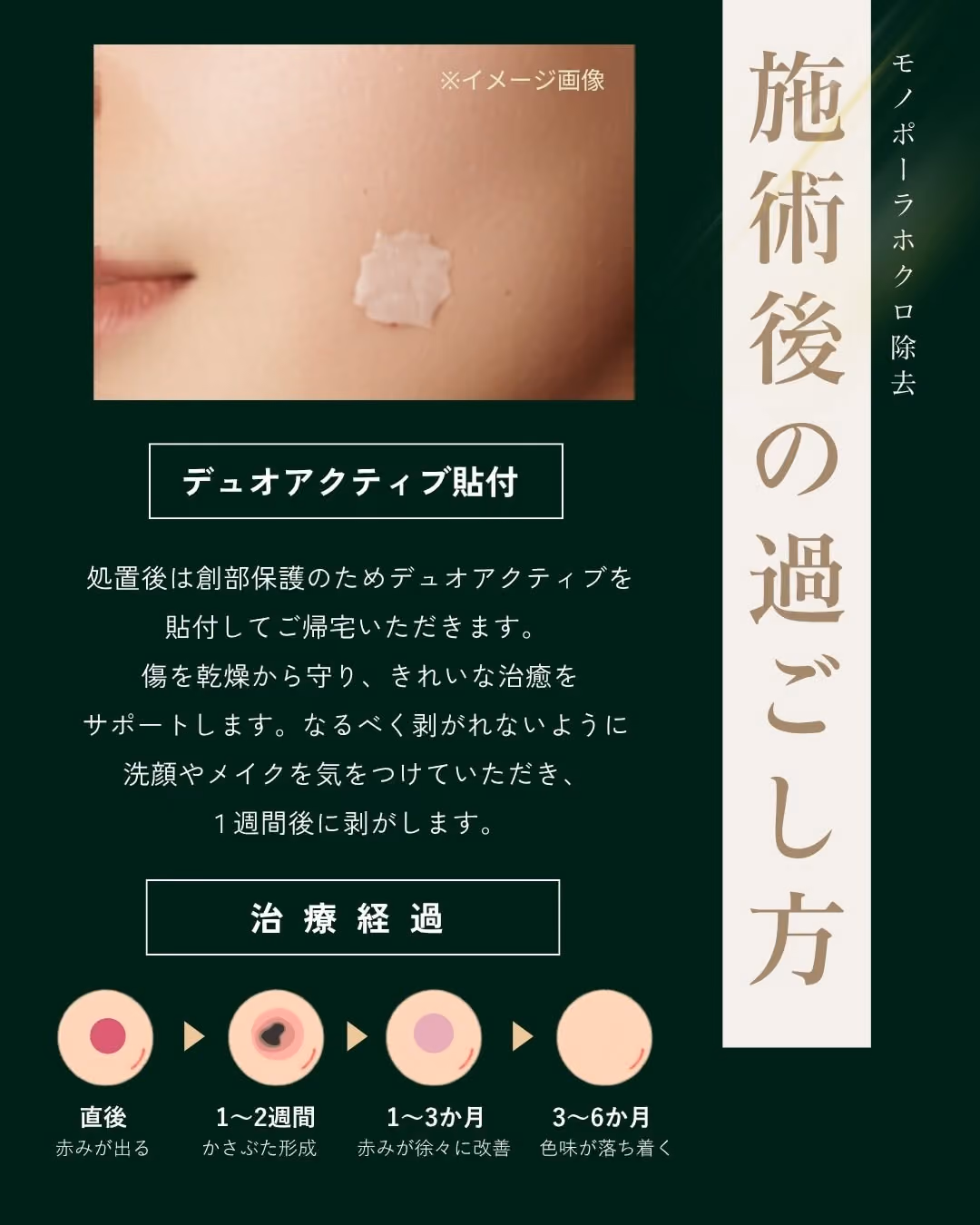 サージトロン(エルマン)モノポーラ高周波