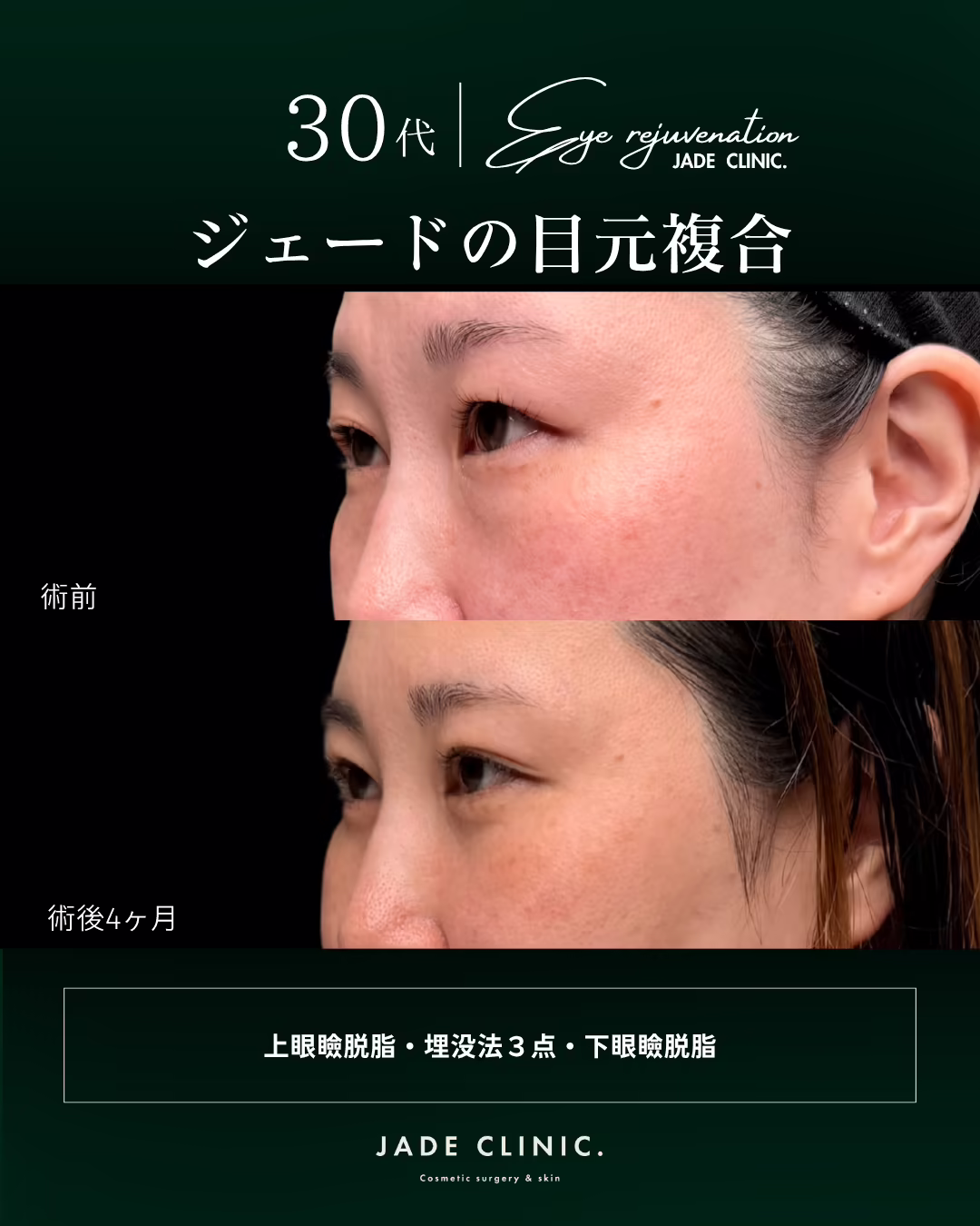 30代女性の目元複合治療（上眼瞼脱脂・埋没法3点・下眼瞼脱脂）の斜め45度ビフォーアフター。上が術前、下が術後4ヶ月。