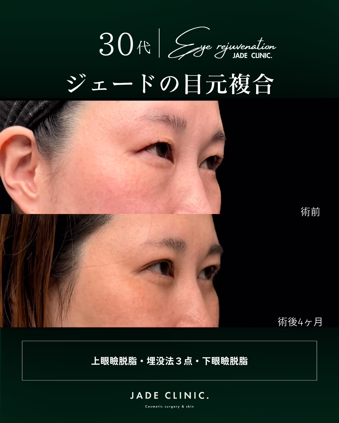 30代女性の目元複合治療（上眼瞼脱脂・埋没法3点・下眼瞼脱脂）の側面ビフォーアフター。上が術前、下が術後4ヶ月。