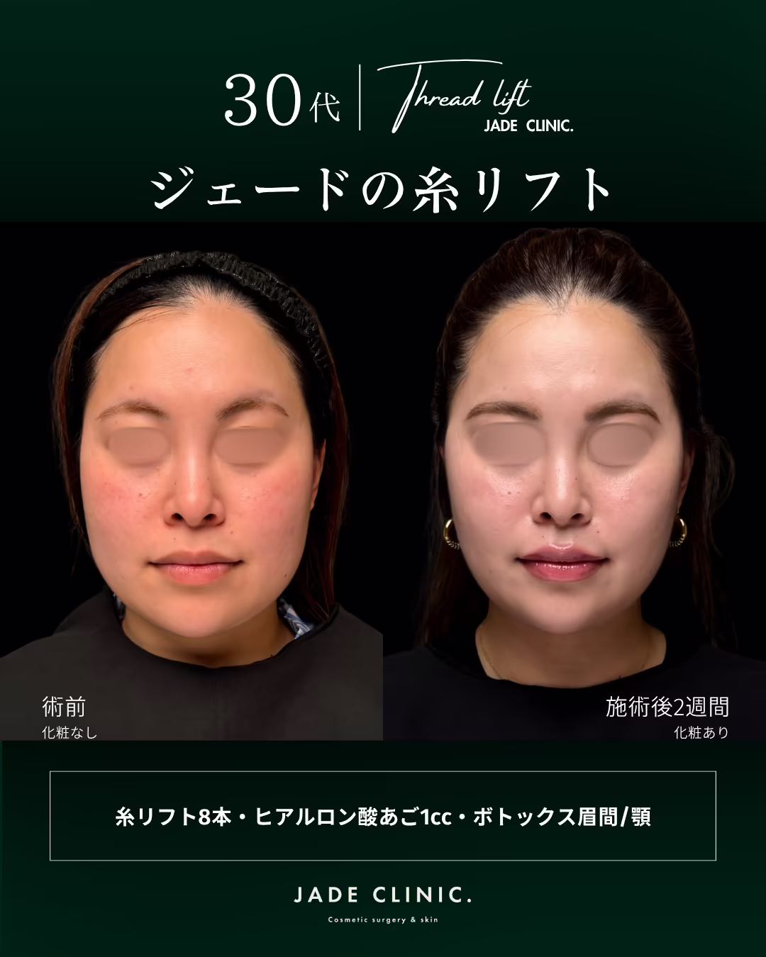 30代女性のフェイスライン糸リフト治療（糸リフト8本・あごヒアルロン酸1cc・眉間と額のボトックス）の正面ビフォーアフター。左が術前、右が術後2週間。目元はモザイク処理。
