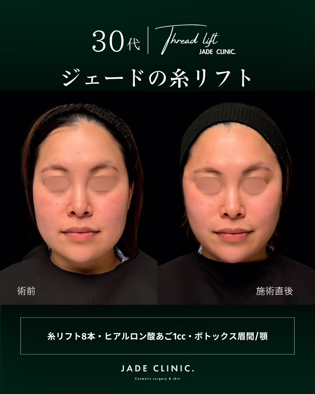 30代女性のフェイスライン糸リフト治療（糸リフト8本・あごヒアルロン酸1cc・眉間と額のボトックス）の正面ビフォーアフター。左が術前、右が施術直後。目元はモザイク処理。