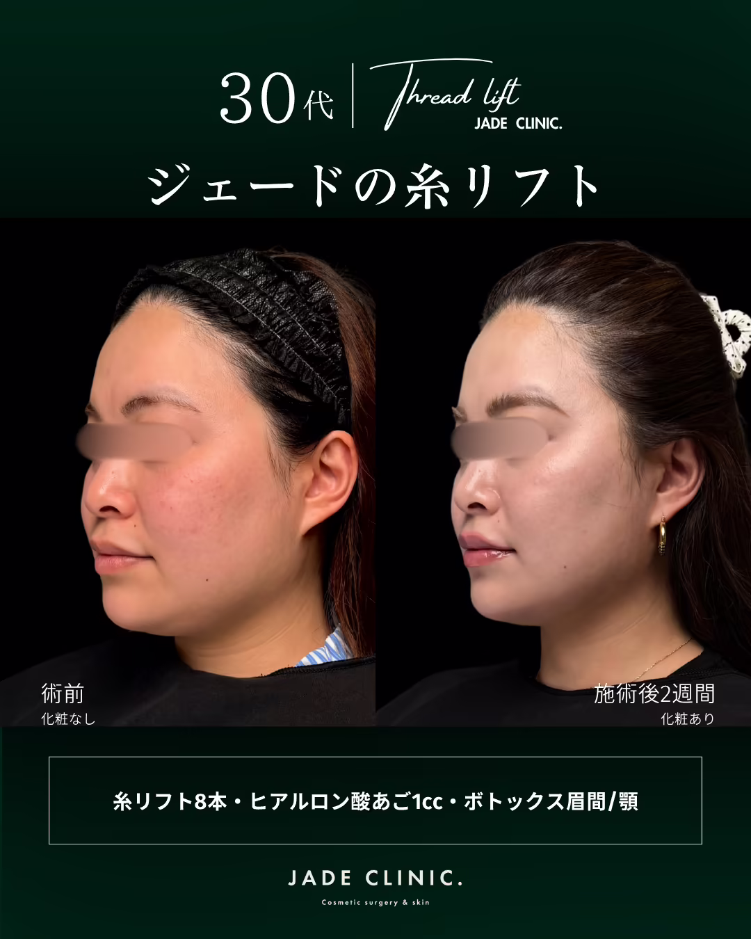 30代女性のフェイスライン糸リフト治療（糸リフト8本・あごヒアルロン酸1cc・眉間と額のボトックス）の斜め45度ビフォーアフター。左が術前、右が術後2週間。目元はモザイク処理。