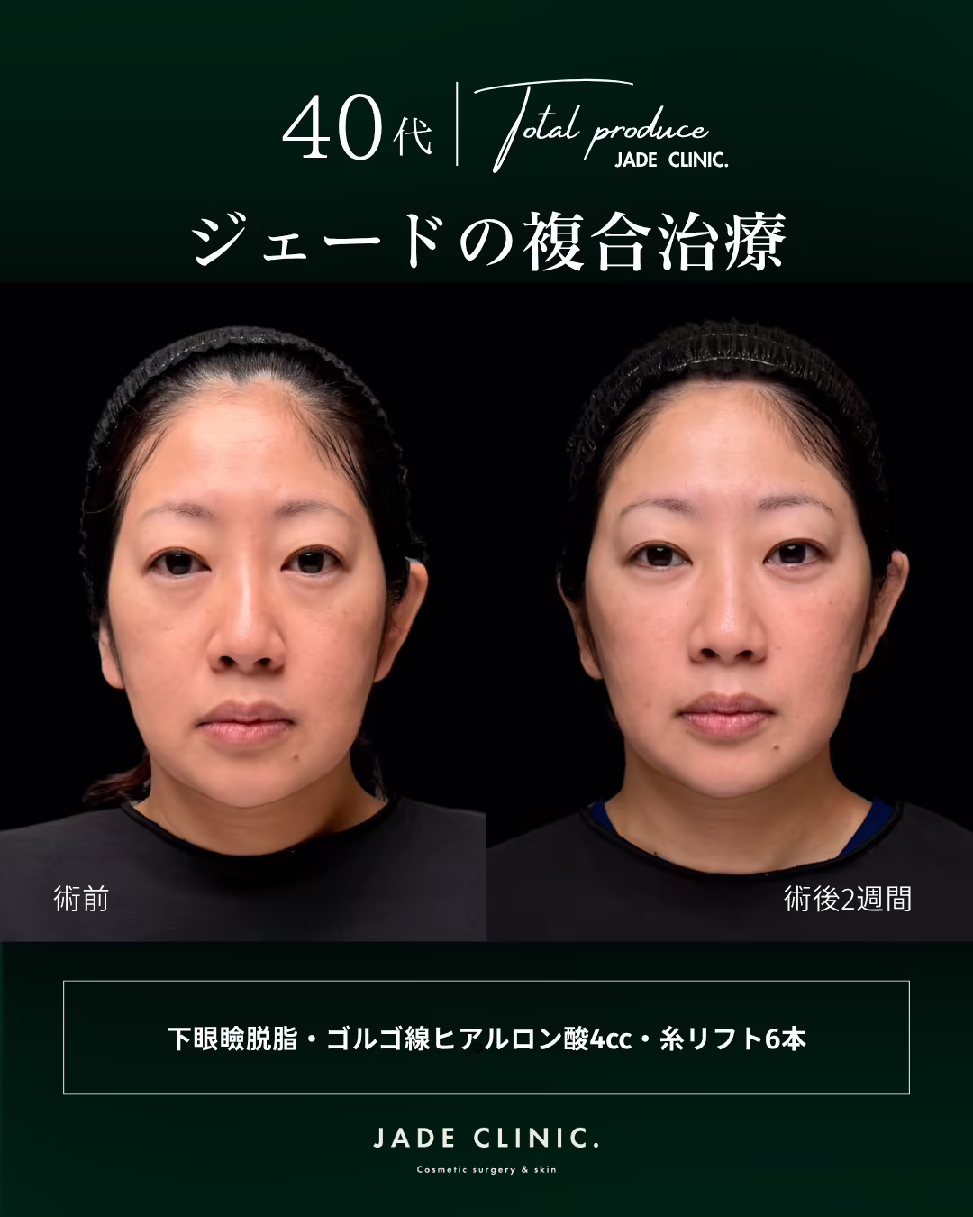 40代女性の複合治療（下眼瞼脱脂・ゴルゴ線へのヒアルロン酸注入4cc・糸リフト6本）の正面ビフォーアフター。左が術前、右が術後2週間。
