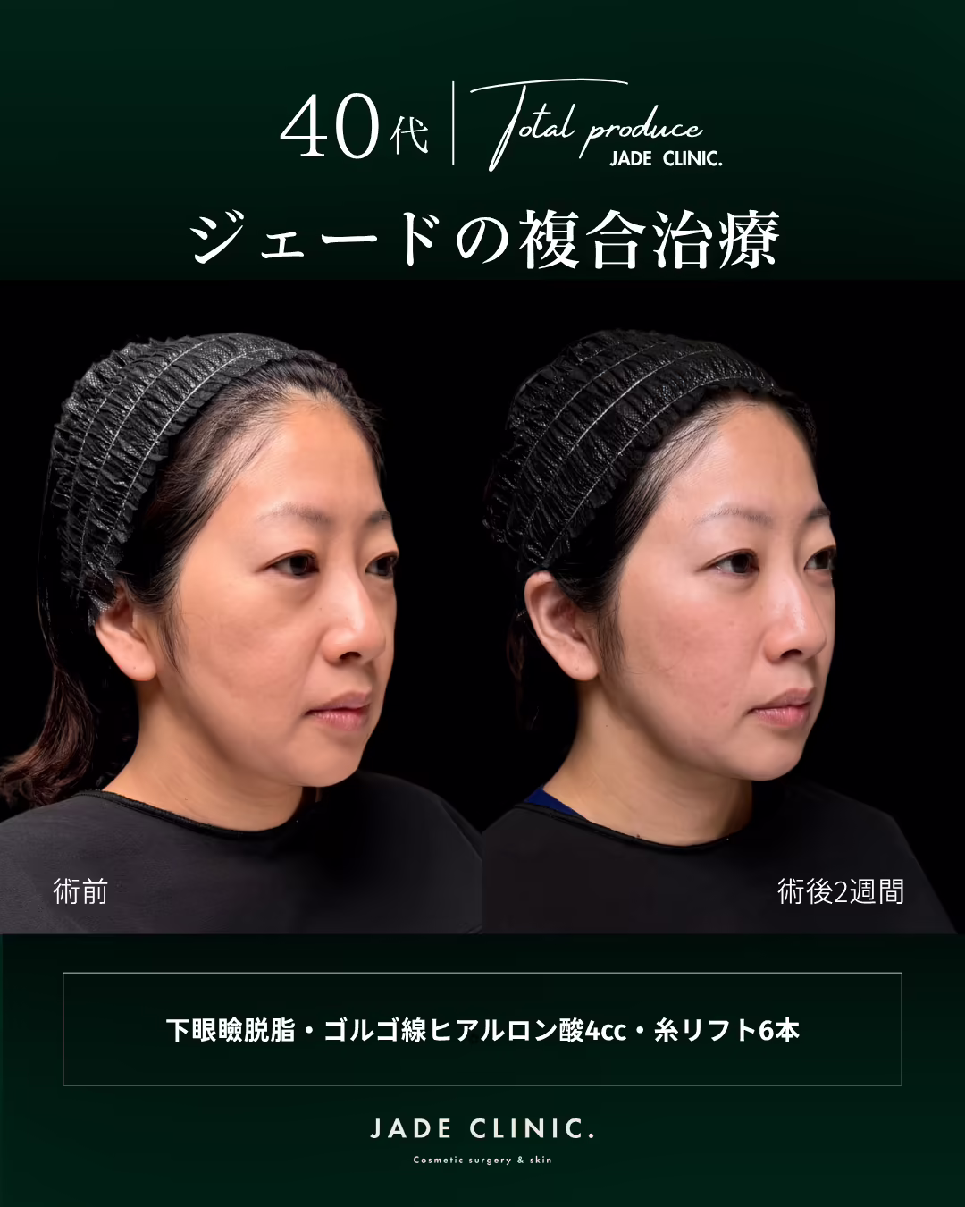 40代女性の複合治療（下眼瞼脱脂・ゴルゴ線へのヒアルロン酸注入4cc・糸リフト6本）の左斜め45度ビフォーアフター。左が術前、右が術後2週間。