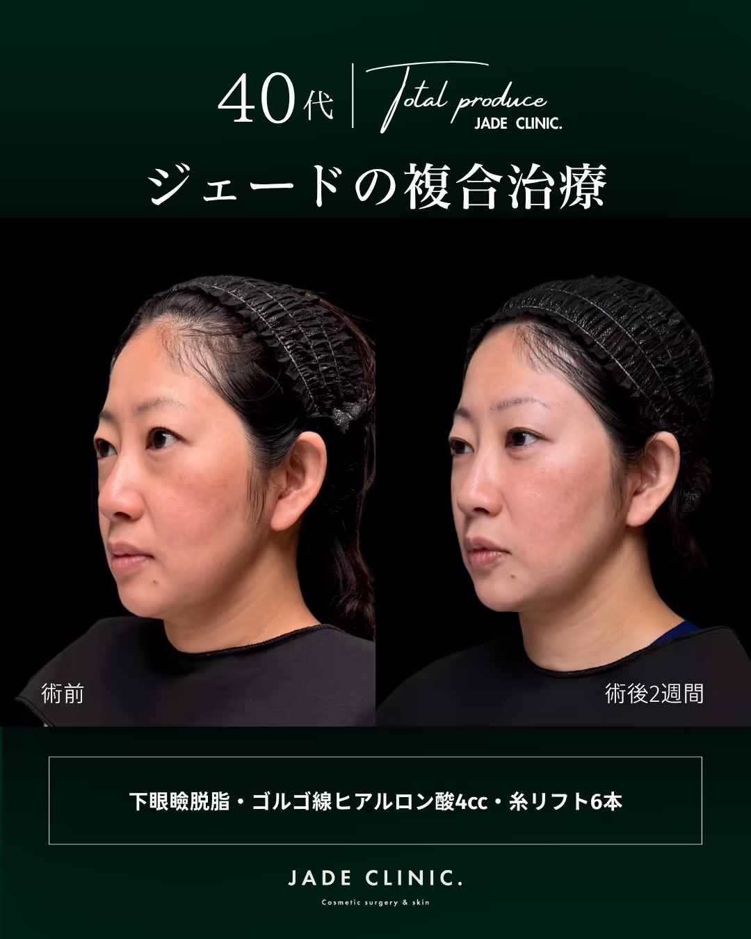 40代女性の複合治療（下眼瞼脱脂・ゴルゴ線へのヒアルロン酸注入4cc・糸リフト6本）の右斜め45度ビフォーアフター。左が術前、右が術後2週間。