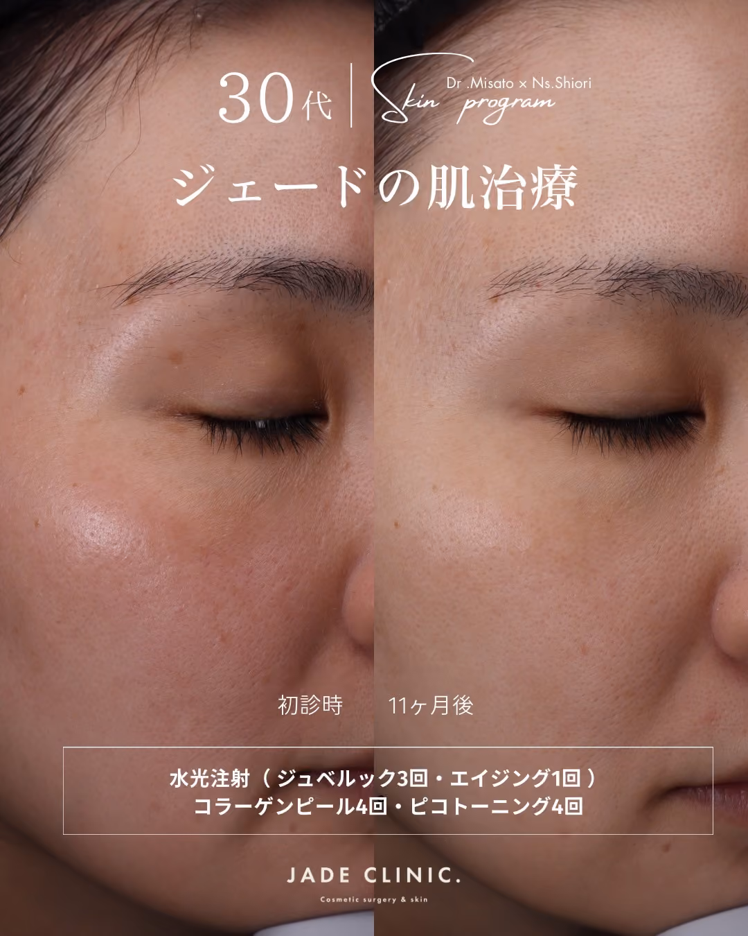 肌育治療1年の変化｜症例タイトル｜JADE CLINIC.