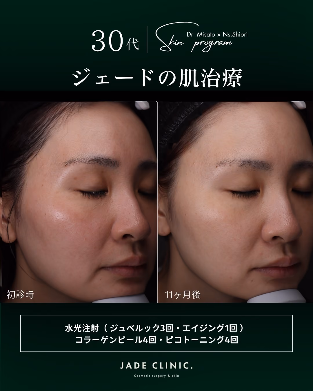 VISIA解析｜赤み・くすみ・真皮老化の評価