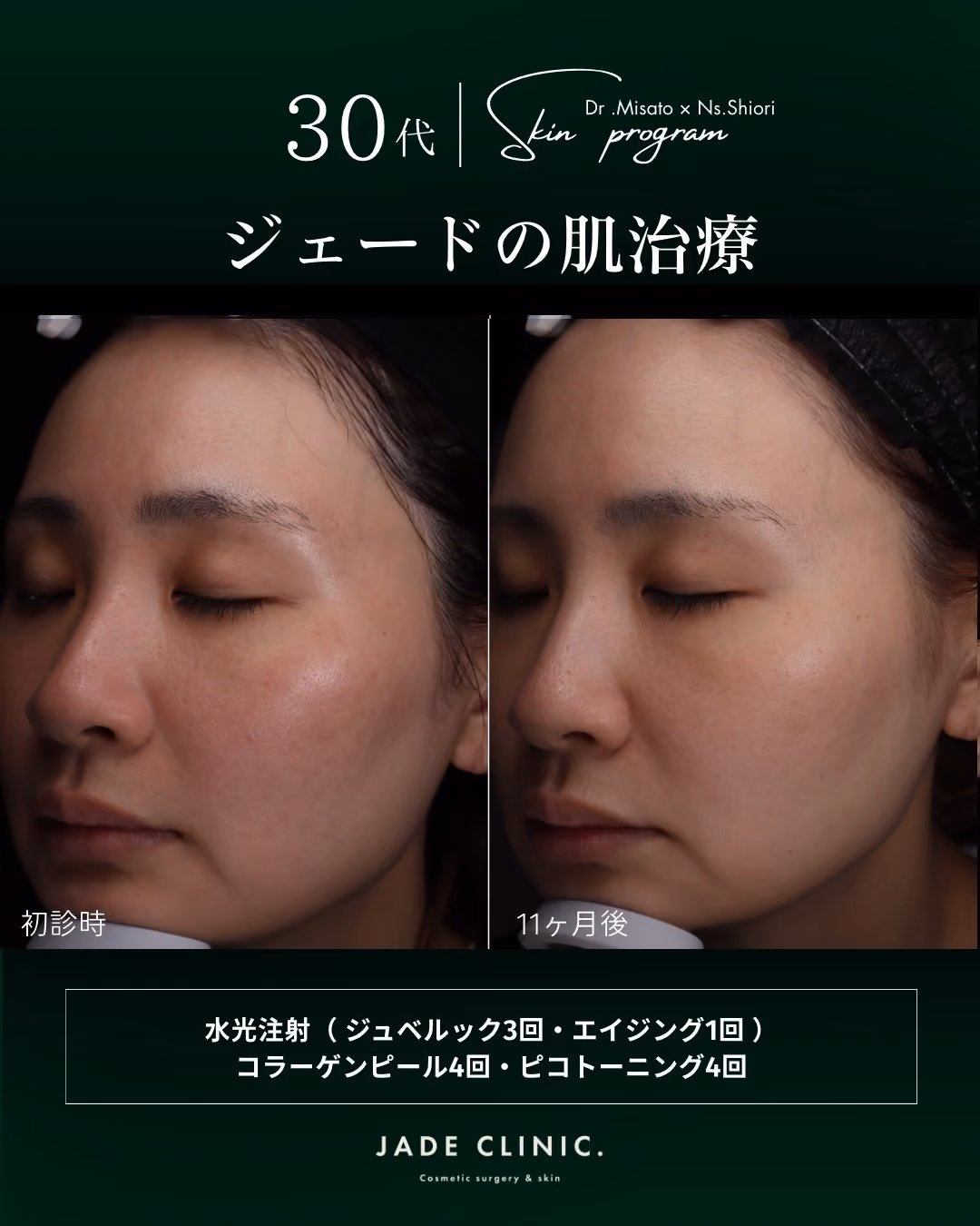 治療前の肌データ
