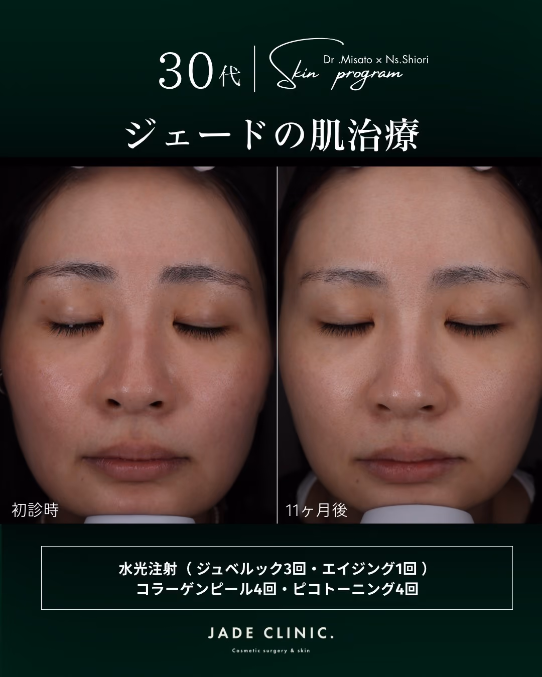 肌育治療1年の変化｜症例4｜JADE CLINIC.