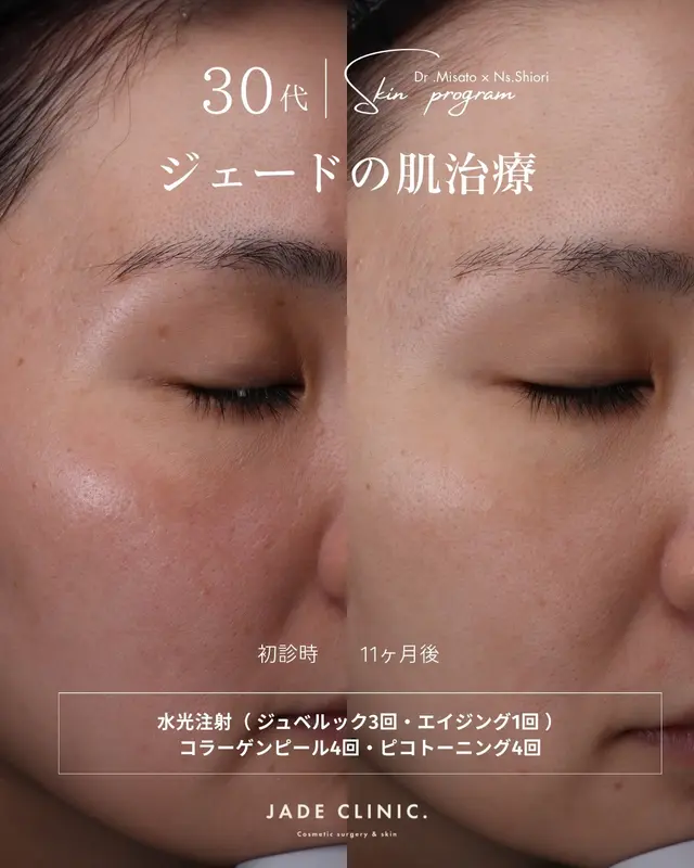 肌を育てる1年の変化｜水光注射・幹細胞・コラーゲンピールの複合治療