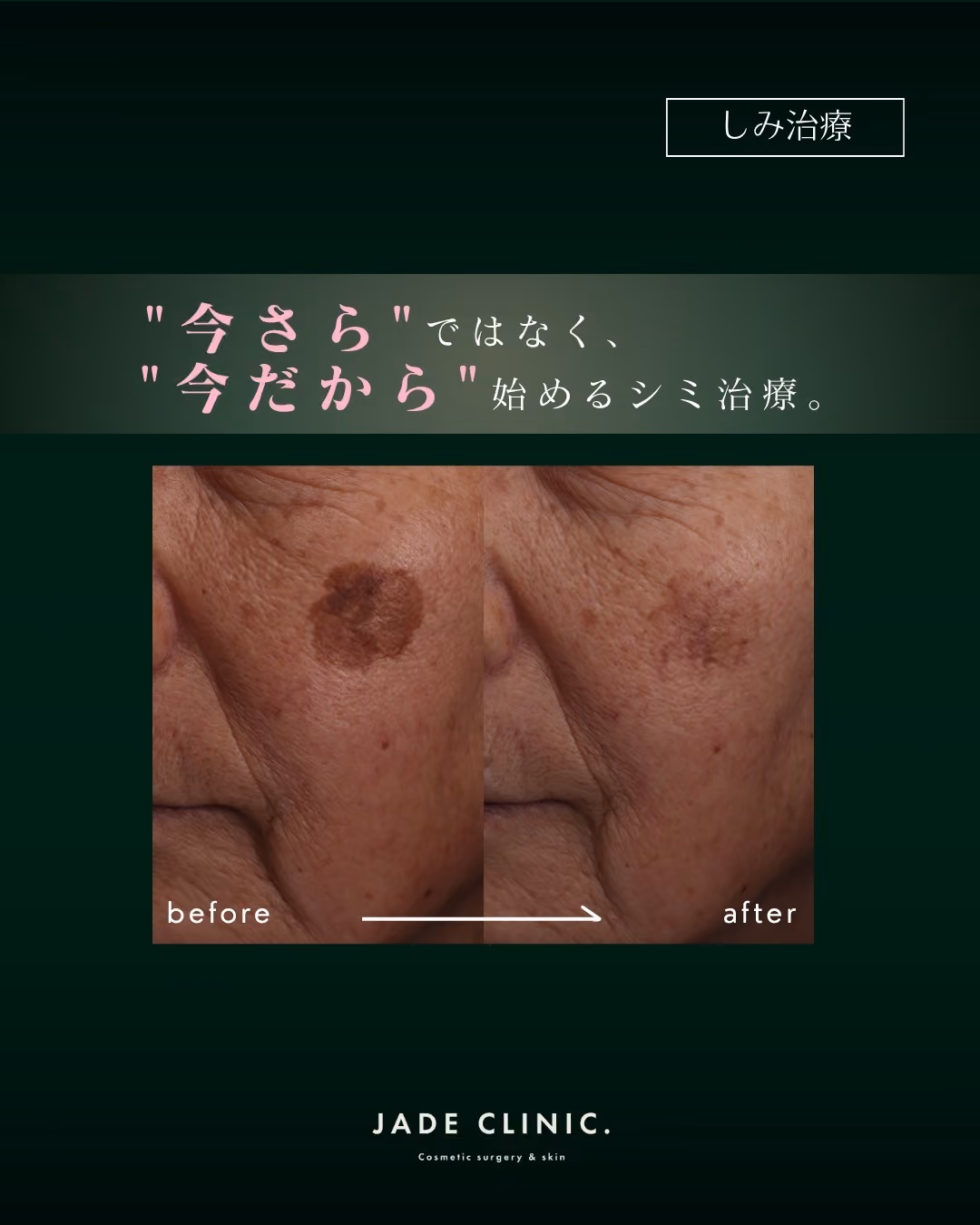 夏のシミ治療｜症例タイトル｜JADE CLINIC.