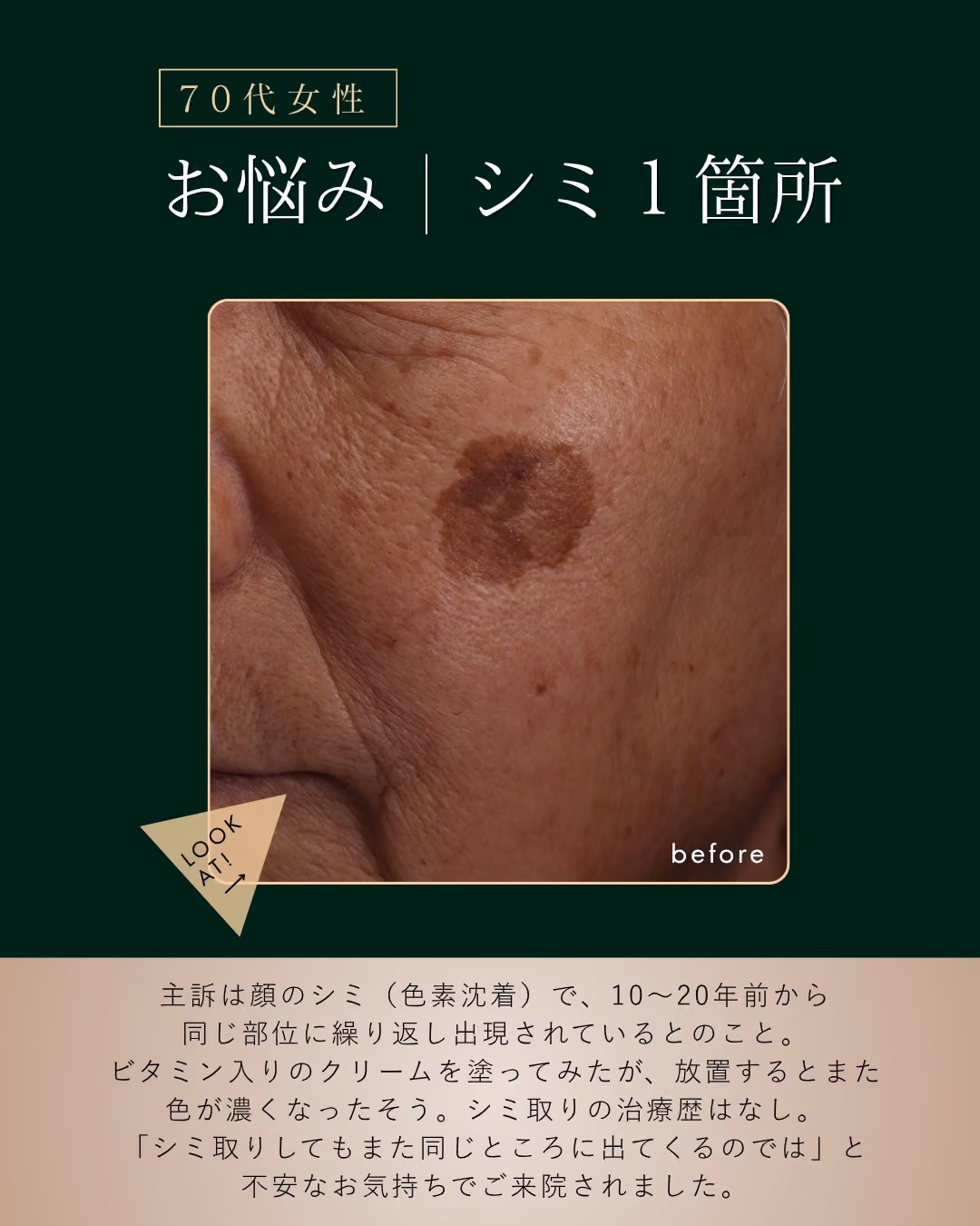 シミの種類の見分け方