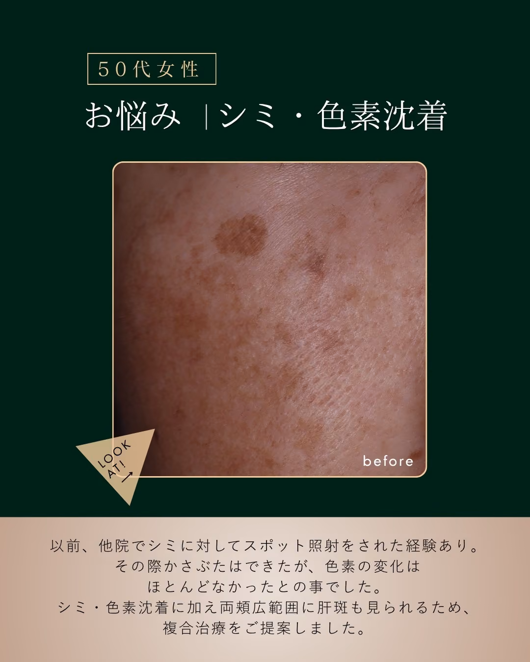 夏のシミ治療｜症例5｜JADE CLINIC.