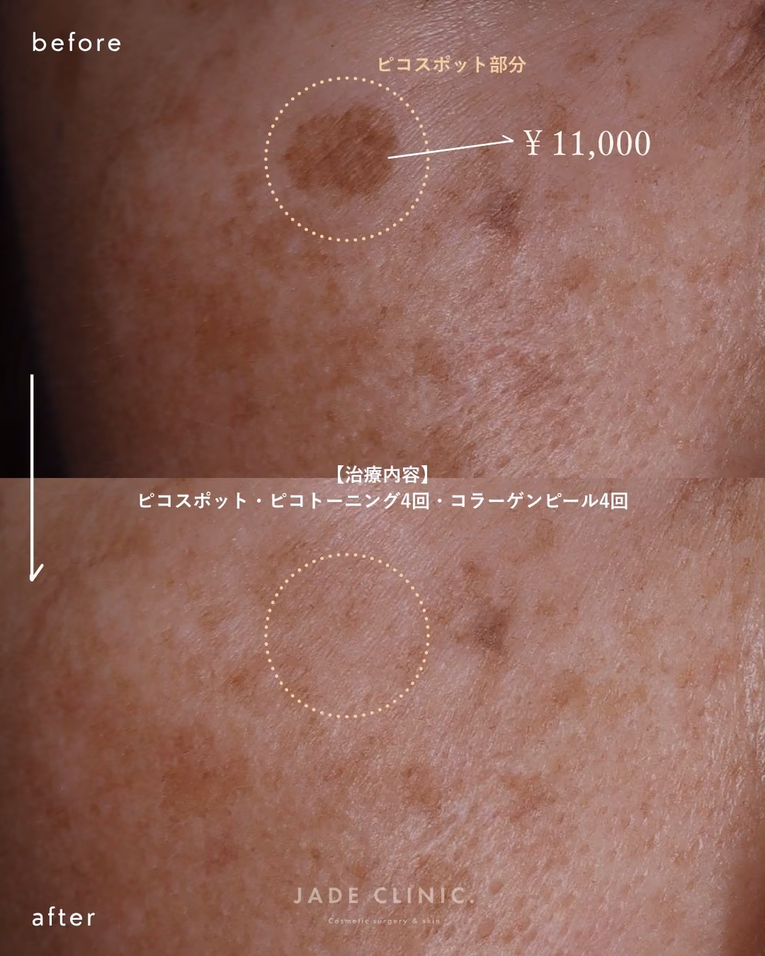 夏のシミ治療｜症例7｜JADE CLINIC.