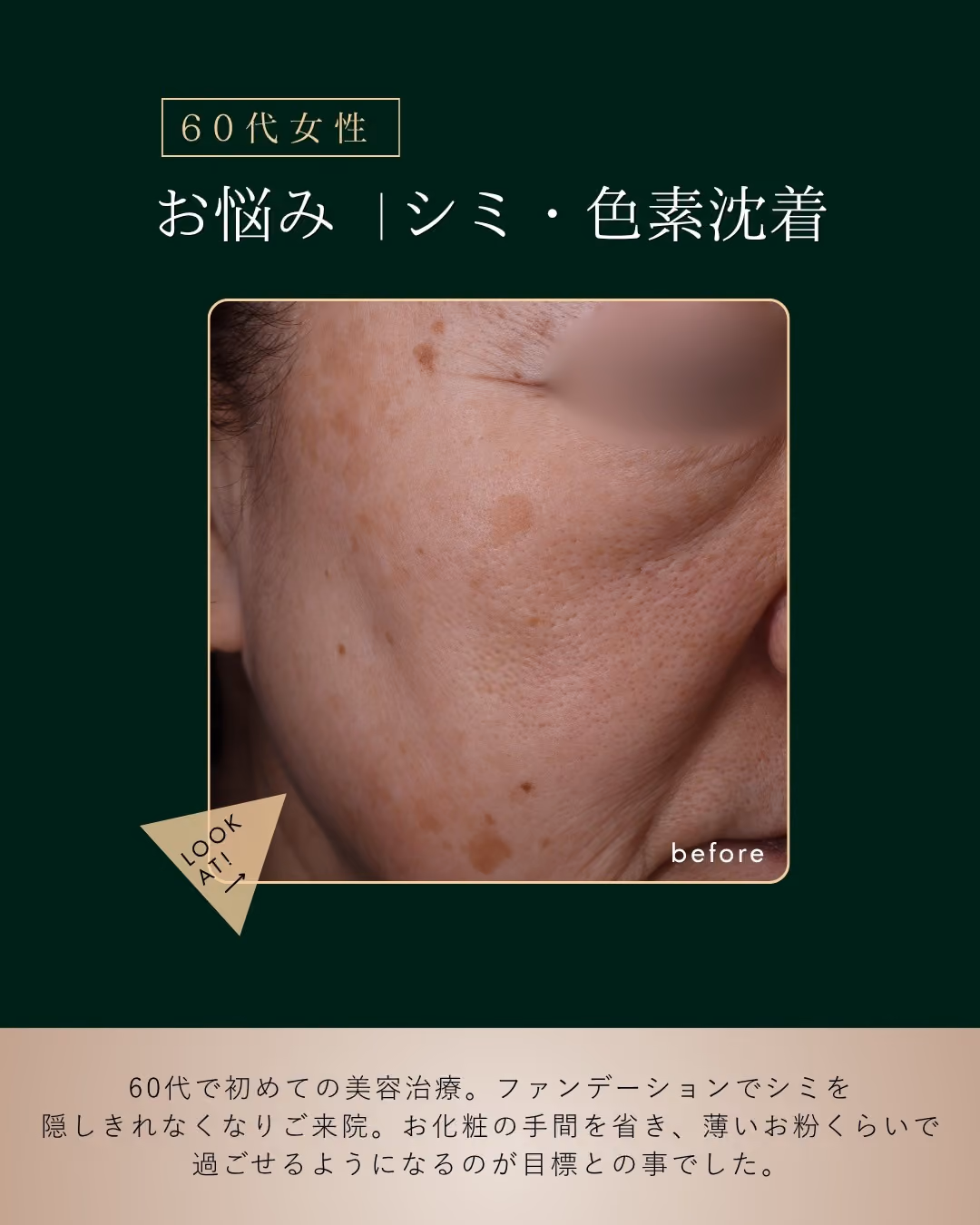 夏のシミ治療｜症例8｜JADE CLINIC.
