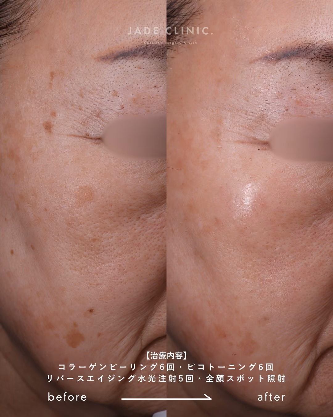 夏のシミ治療｜症例10｜JADE CLINIC.