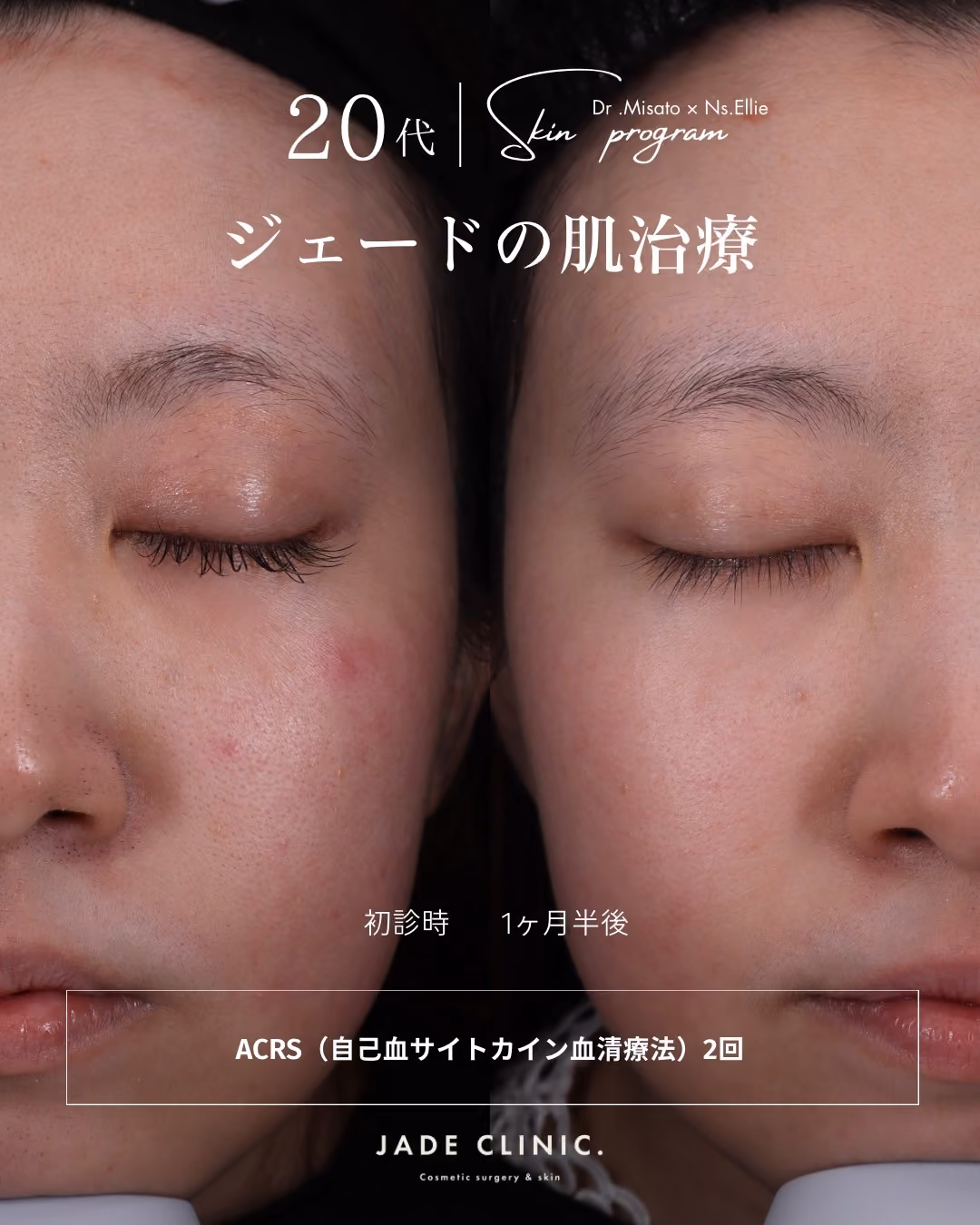 ACRS自己血サイトカイン治療｜症例タイトル｜JADE CLINIC.