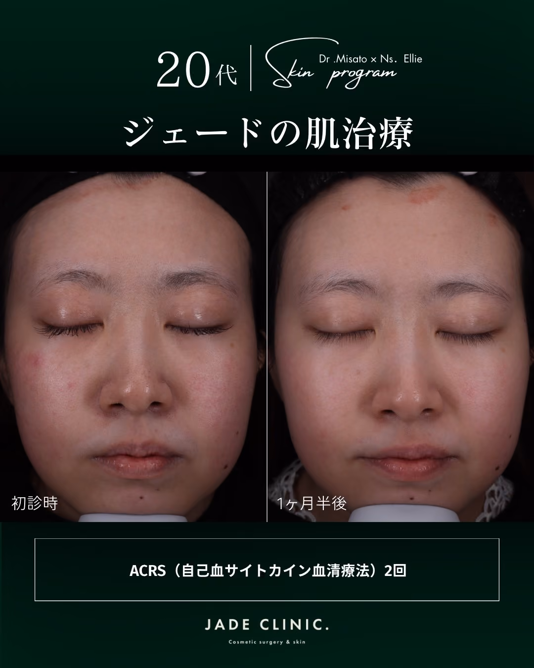 治療前｜年中肌荒れ・赤み・乾燥